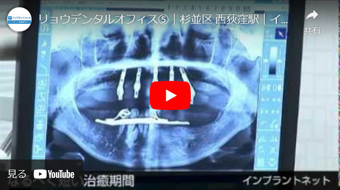 ショートインプラント解説動画
