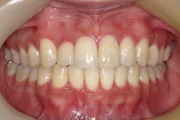 After image
