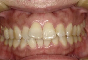 矯正治療症例　治療前