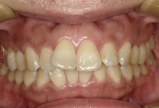 矯正治療症例 治療前