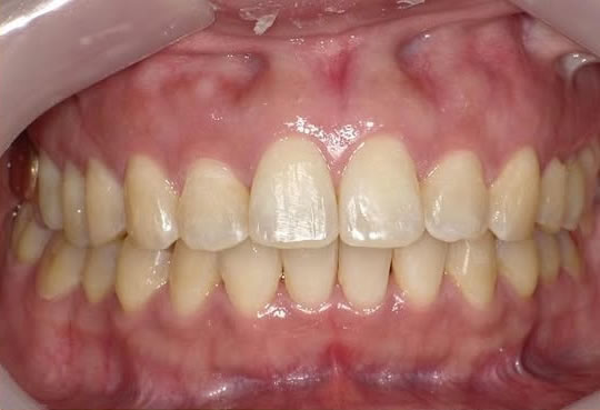 矯正治療症例 治療後