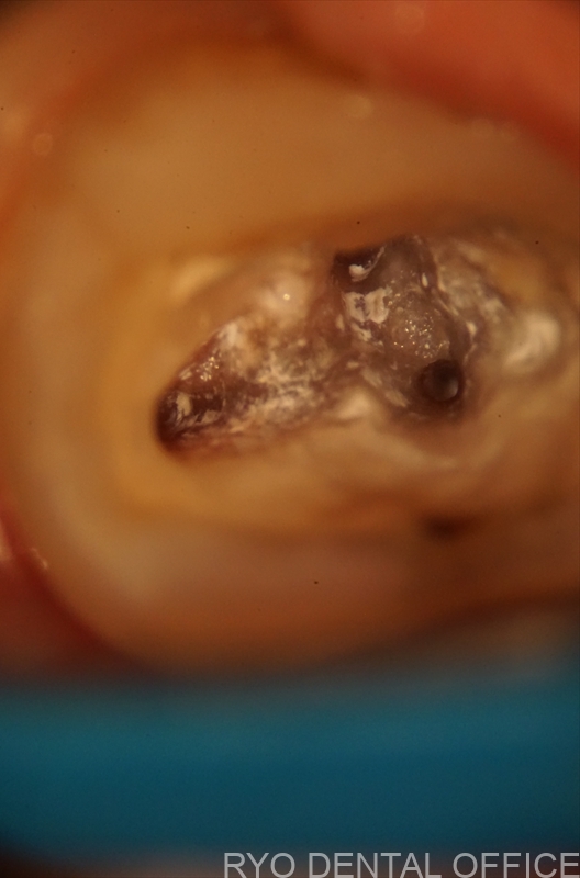 顕微鏡根管治療症例