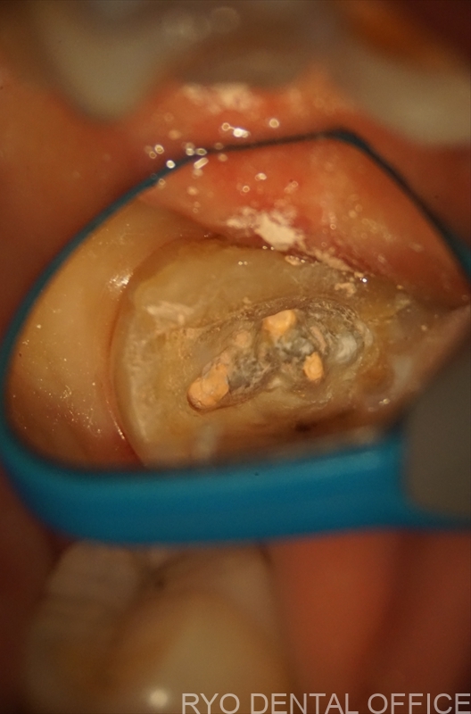 顕微鏡根管治療症例