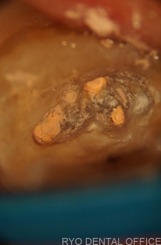 顕微鏡根管治療症例