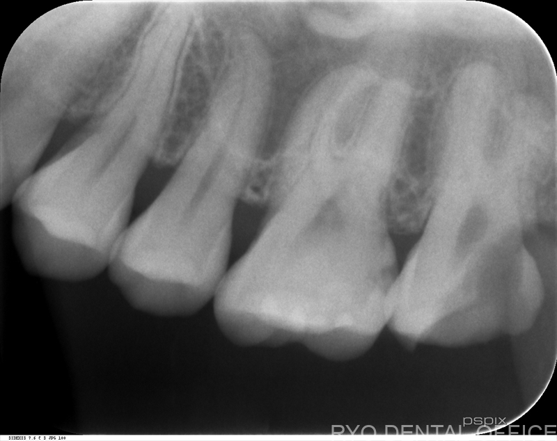 顕微鏡根管治療症例