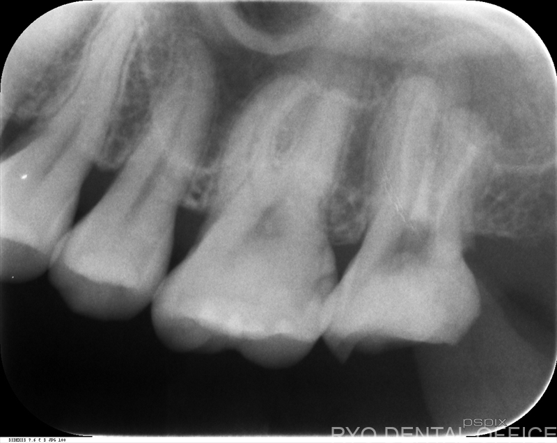 顕微鏡根管治療症例