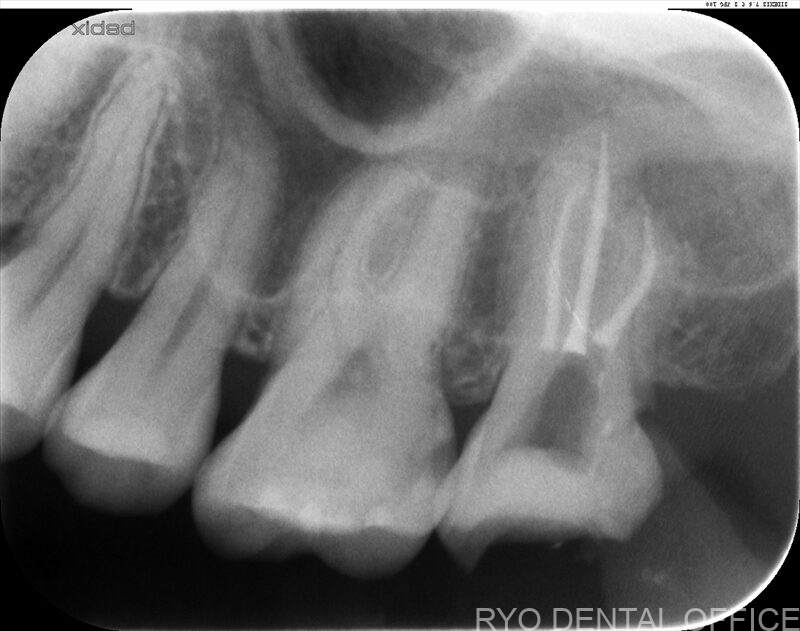 顕微鏡根管治療症例