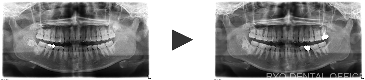 顕微鏡根管治療症例