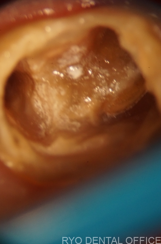 顕微鏡根管治療症例