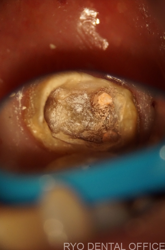 顕微鏡根管治療症例