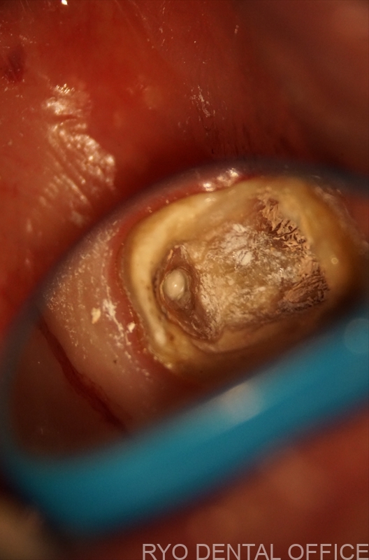 顕微鏡根管治療症例