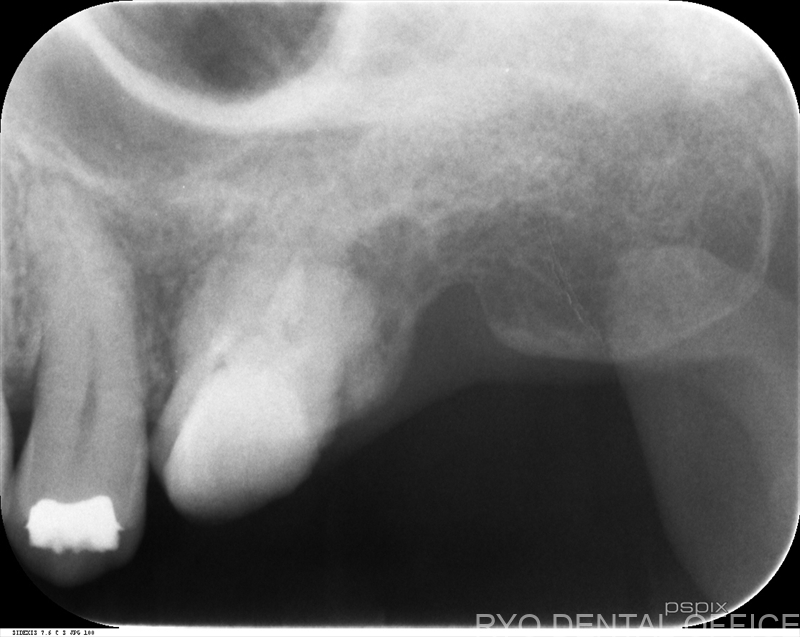 顕微鏡根管治療症例