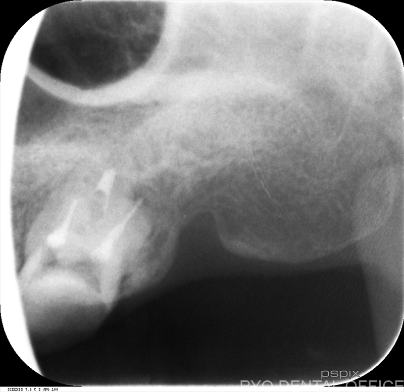 顕微鏡根管治療症例