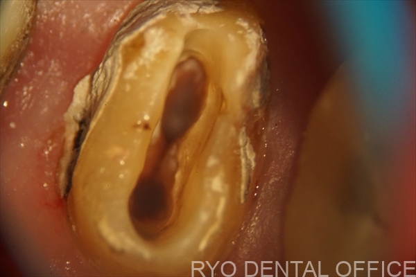 顕微鏡根管治療症例