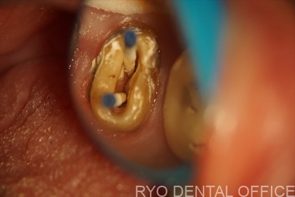 顕微鏡根管治療症例