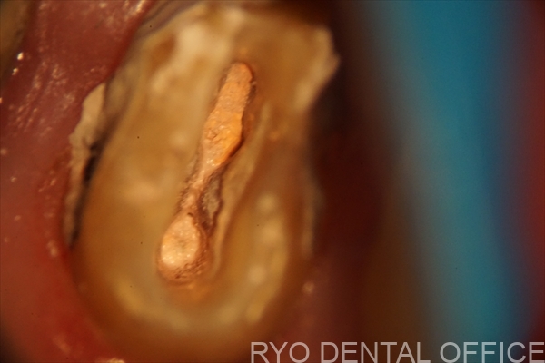 顕微鏡根管治療症例