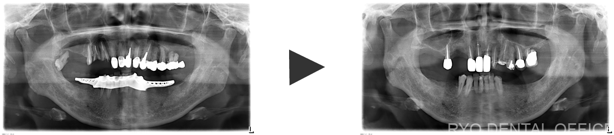 治療前後のレントゲン画像