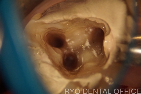 顕微鏡根管治療症例