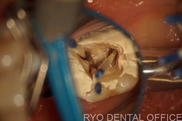 顕微鏡根管治療症例