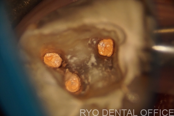 顕微鏡根管治療症例