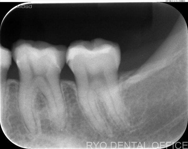 顕微鏡根管治療症例