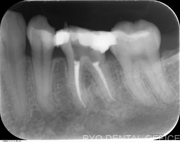 顕微鏡根管治療症例