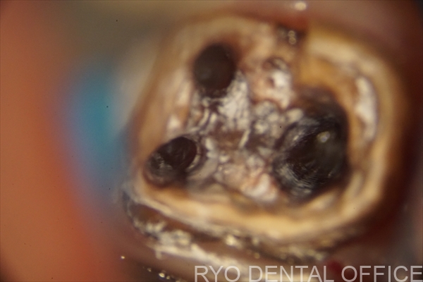 顕微鏡根管治療症例