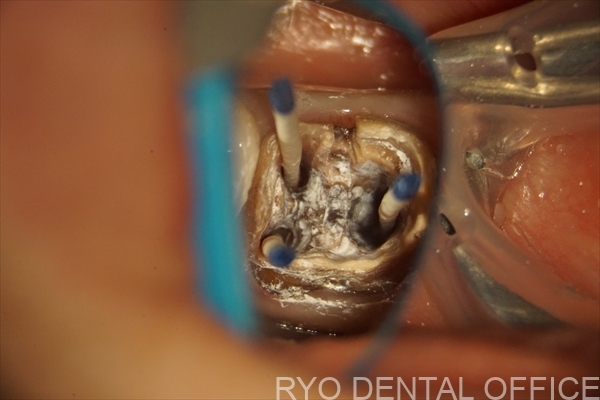 顕微鏡根管治療症例