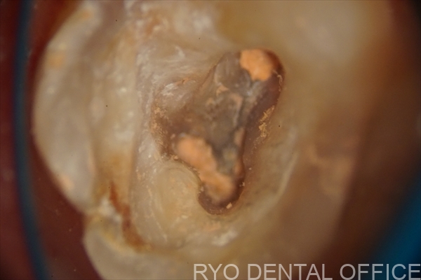 顕微鏡根管治療症例