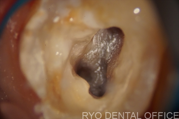 顕微鏡根管治療症例