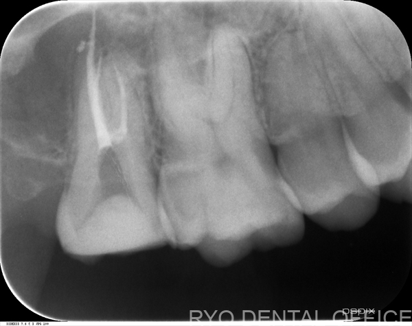 顕微鏡根管治療症例