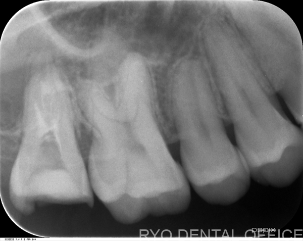 顕微鏡根管治療症例