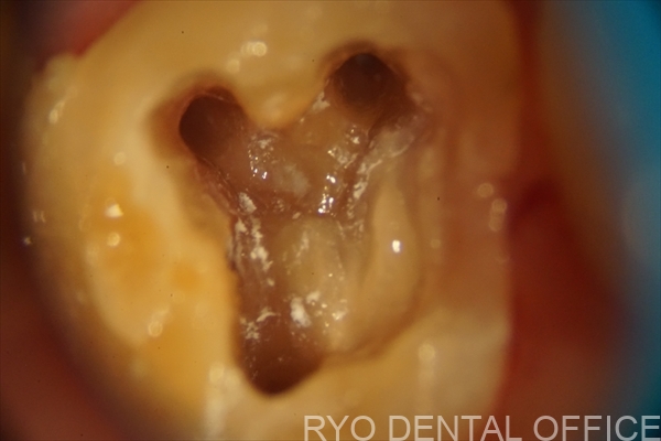 顕微鏡根管治療症例