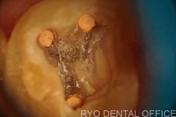 顕微鏡根管治療症例
