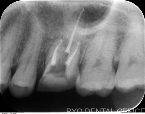 顕微鏡根管治療症例