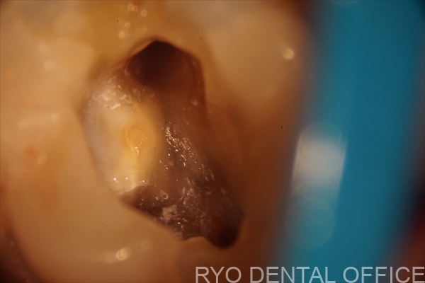 顕微鏡根管治療症例