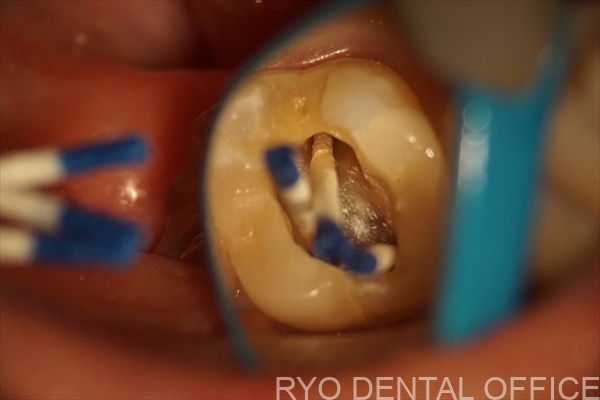 顕微鏡根管治療症例