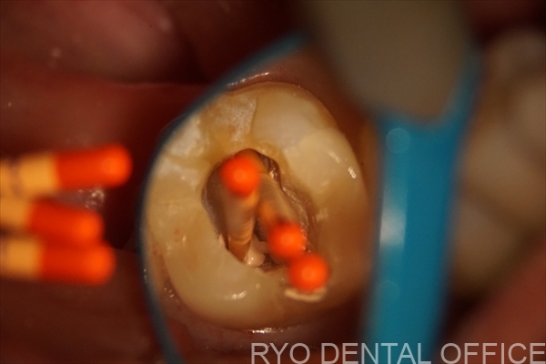 顕微鏡根管治療症例