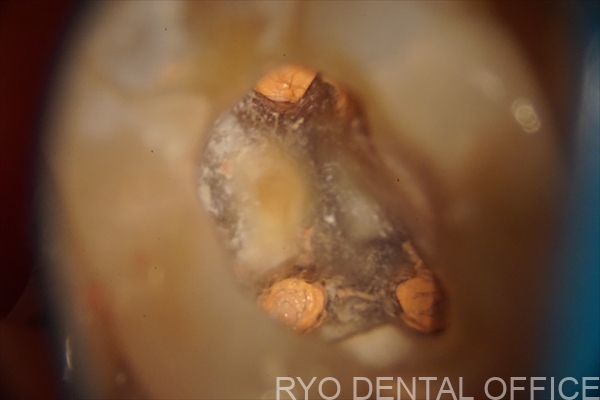 顕微鏡根管治療症例