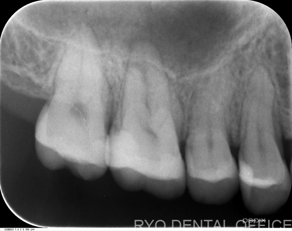 顕微鏡根管治療症例