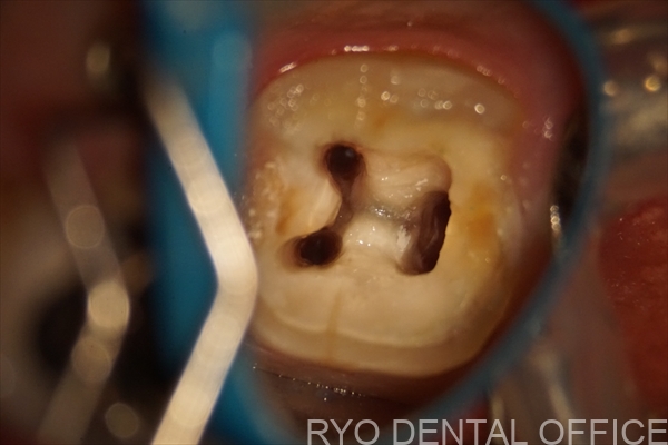 顕微鏡根管治療症例