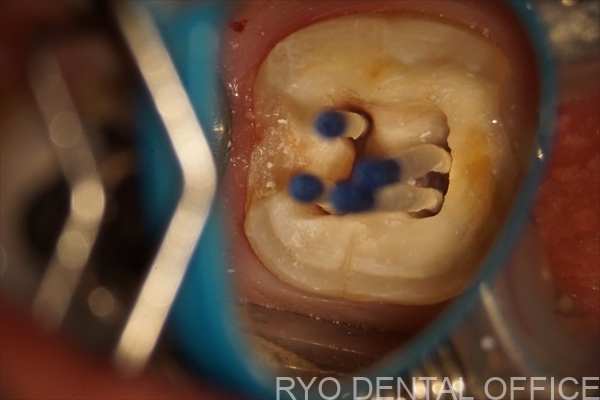 顕微鏡根管治療症例