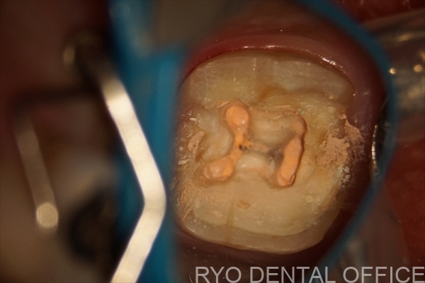 顕微鏡根管治療症例