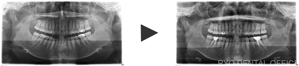 治療前後のレントゲン画像