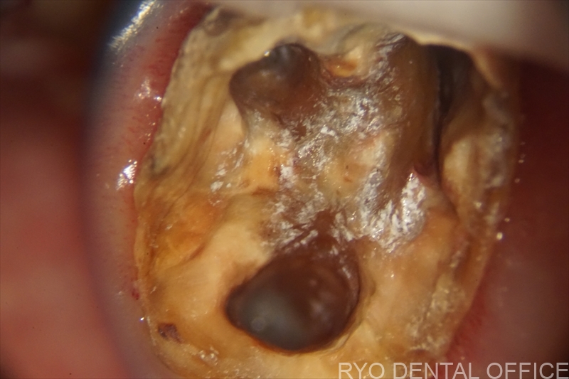 顕微鏡根管治療症例