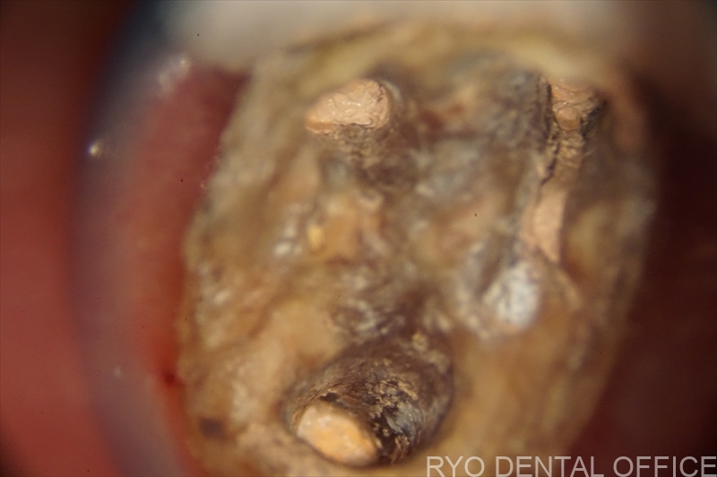 顕微鏡根管治療症例