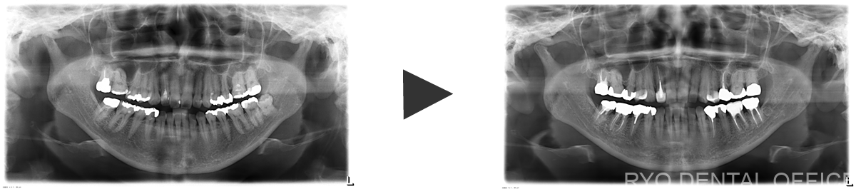 治療前後のレントゲン画像