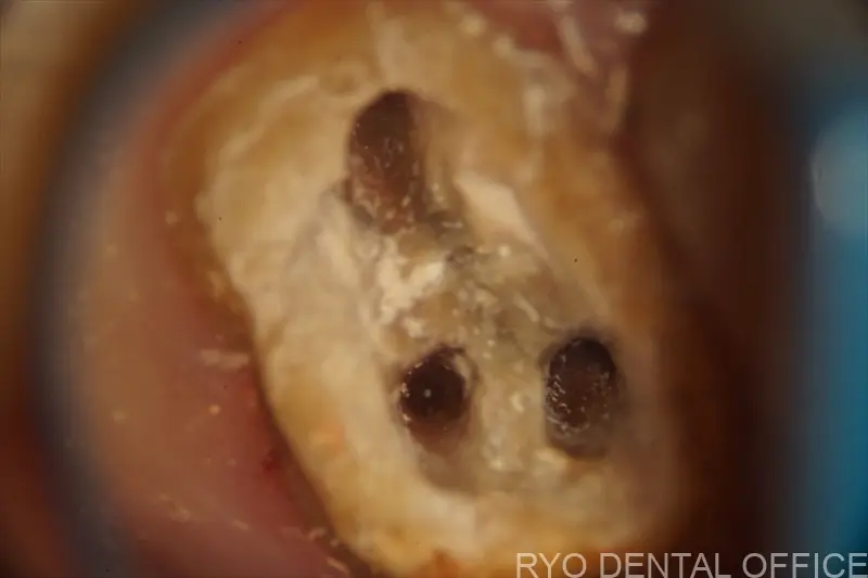 顕微鏡根管治療症例