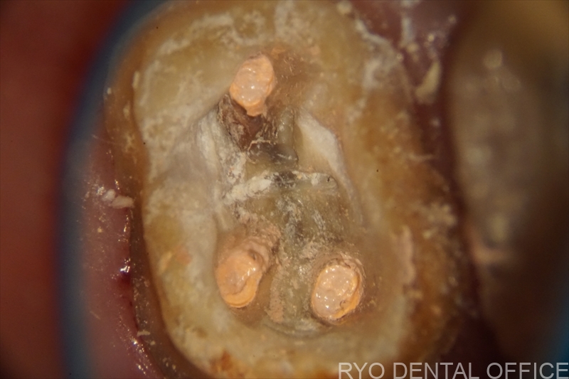 顕微鏡根管治療症例