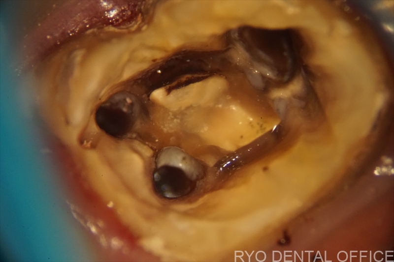 顕微鏡根管治療症例